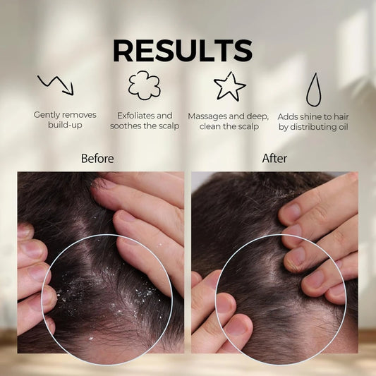 Scalp massage silicone scalp scrubber and exfoliator for dandruff and hair growth, scalp brush for wet and dry hair